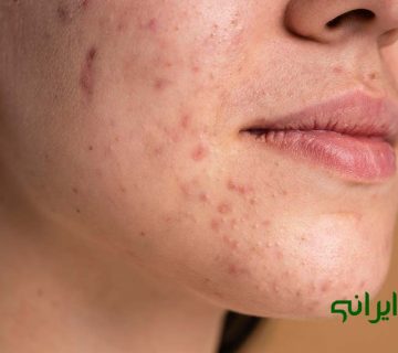 داروی گیاهی برای جوش صورت