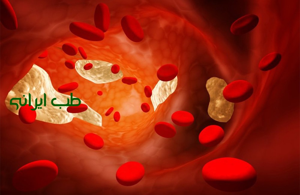 کاهش سریع چربی چربی خون در طب سنتی