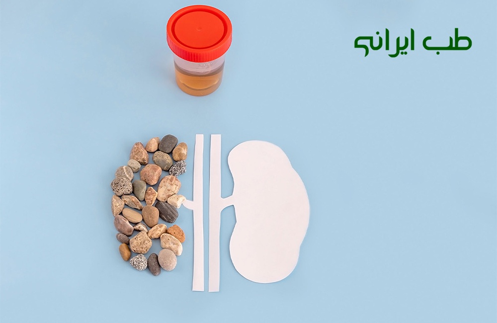 درمان سنگ کلیه در طب سنتی