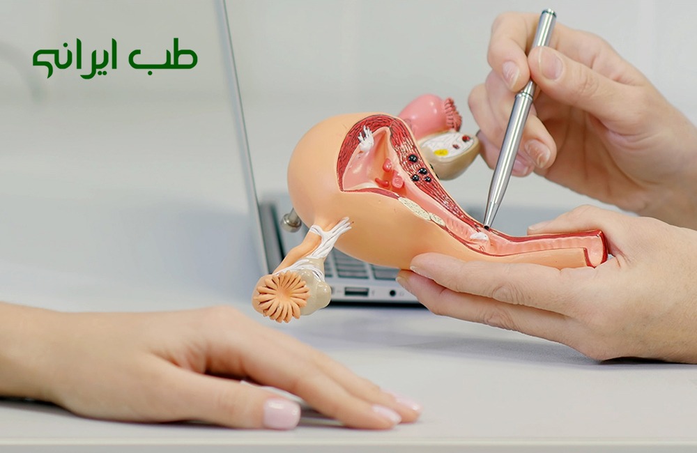 درمان فیبروم رحم با طب سنتی