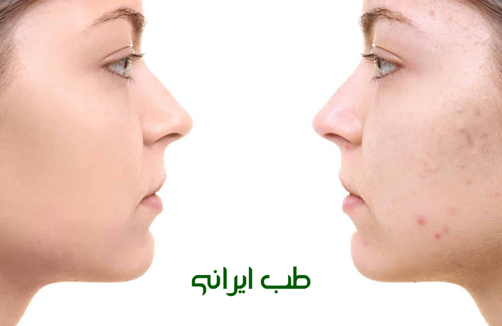 حجامت برای جوش صورت