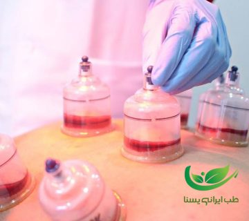 بهترین زمان برای حجامت خانم ها