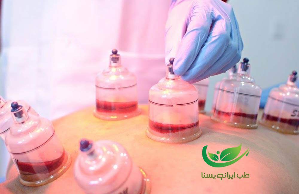 بهترین زمان برای حجامت خانم ها
