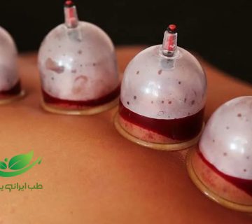 حجامت نقره