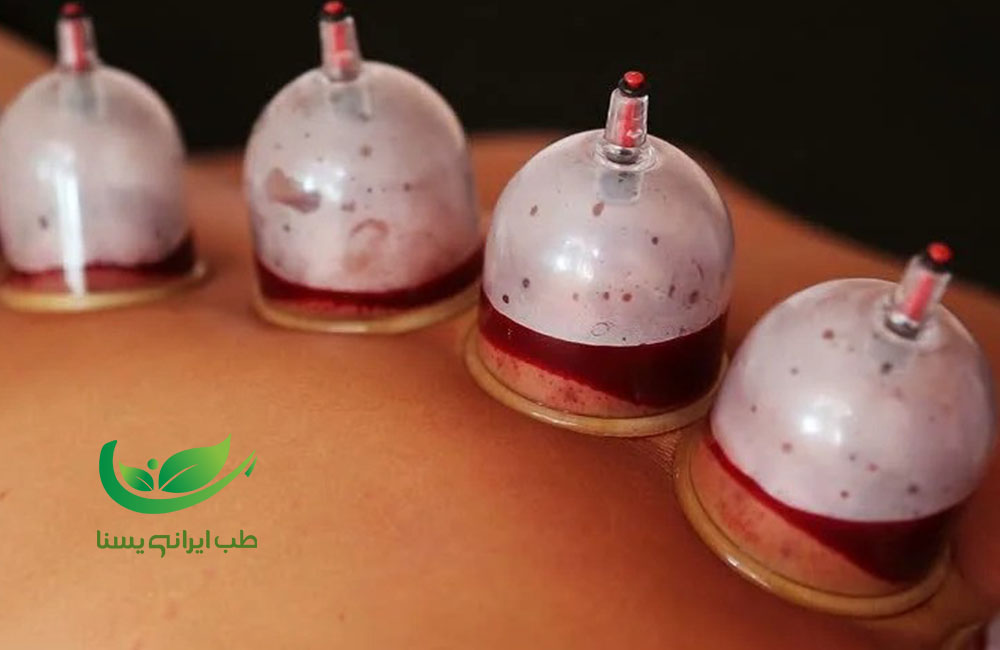 حجامت نقره